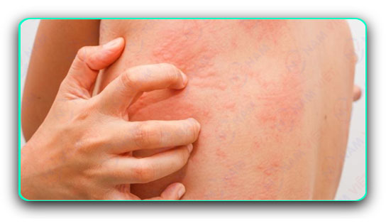 Chẩn đoán và điều trị bệnh mề đay