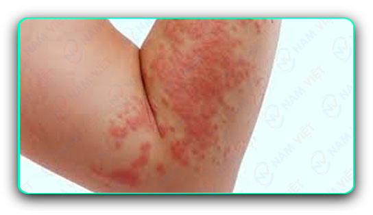 Chẩn đoán và điều trị bệnh mề đay