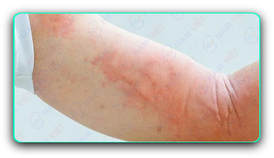 Chẩn đoán và điều trị bệnh mề đay